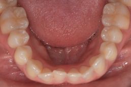 Teeth before 1 Clear Aligners