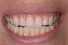 Women's teeth after whitening