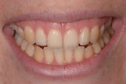 Women's teeth before whitening