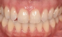 Teeth afterac 2 Clear Aligners