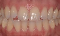 Teeth before 2 Clear Aligners