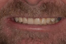 Man teeth after Composite bonding