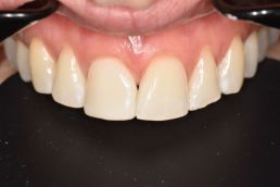 teeth after composite bonding