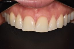 teeth before composite bonding