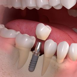 Implant borne single tooth treatment 03 uai