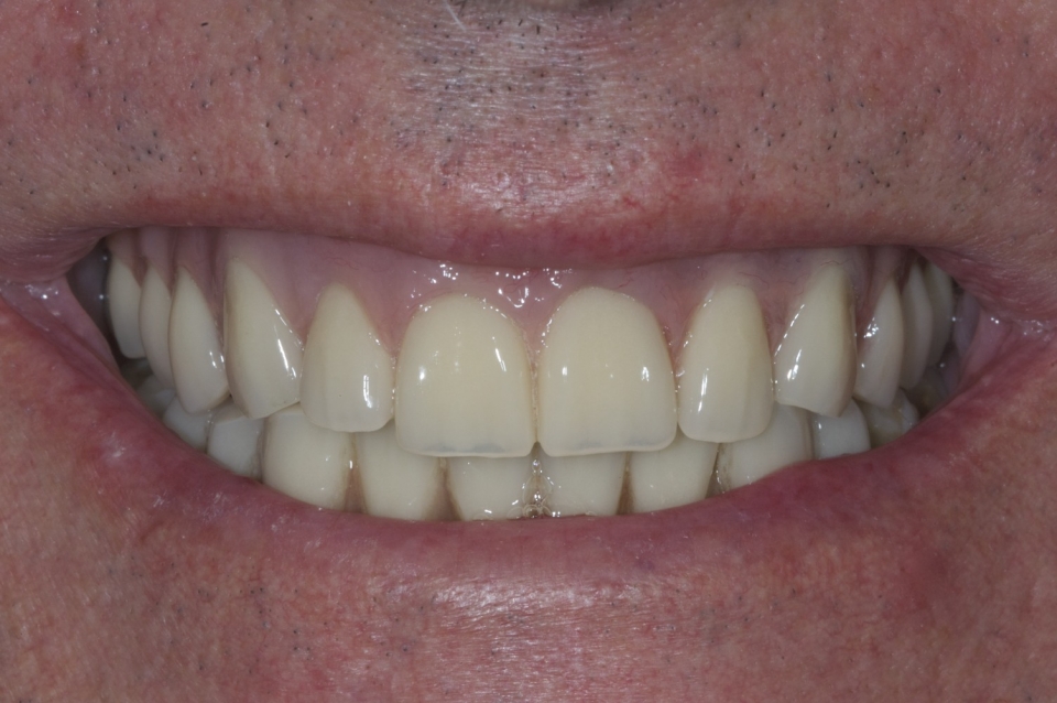 Dental Implants Dental Treatments By Green Room Dentistry