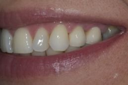 Dental Implants Results