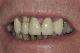 Dental Implants results