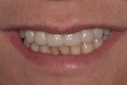 Perfect teeth after dentistry bridge