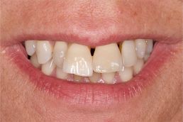 Perfect teeth before dentistry bridge