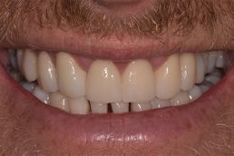 Man's teeth after crowns