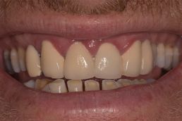 Man's teeth before crowns