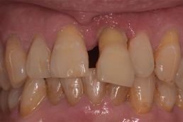photo of teeth before dentist